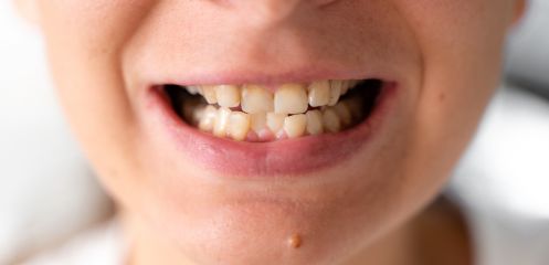 Stained or yellowed teeth